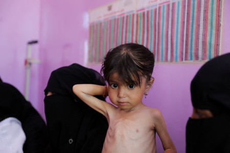 Malnutrition worsening in Yemen’s government-controlled areas, UN says